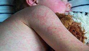 America’s measles comeback